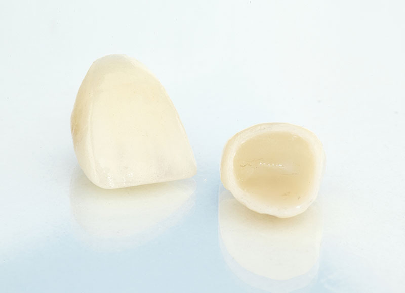 dental crowns in kitchener