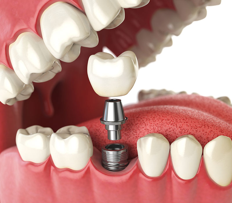 dental implants in kitchener