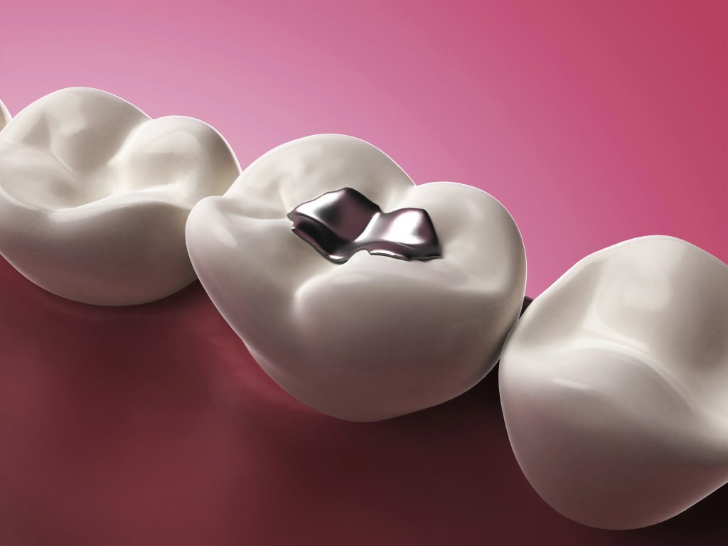 all about white fillings by our dentist in kitchener