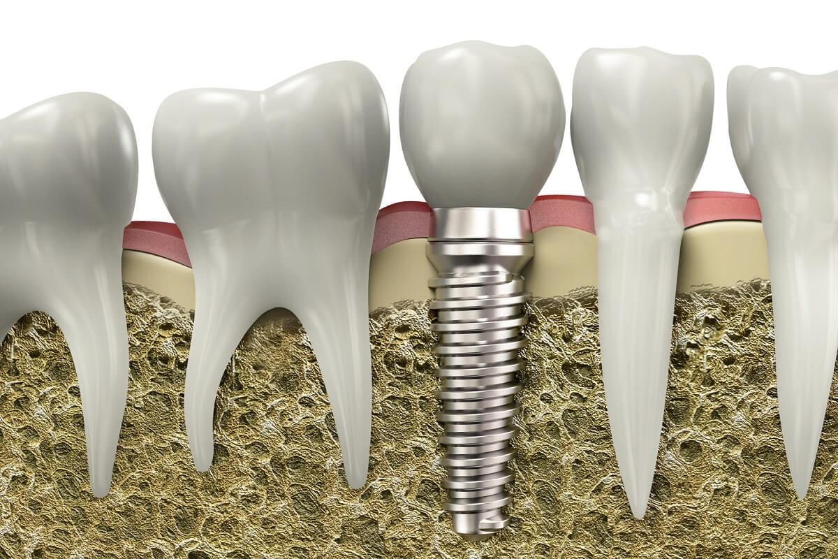 how dental implants improve your oral health and quality of life