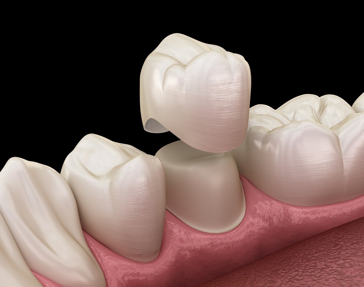 the importance of dental crowns in restoring oral health