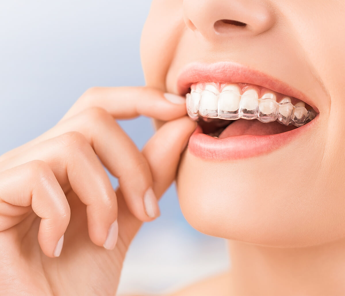 why invisalign is a game changer in orthodontic treatment