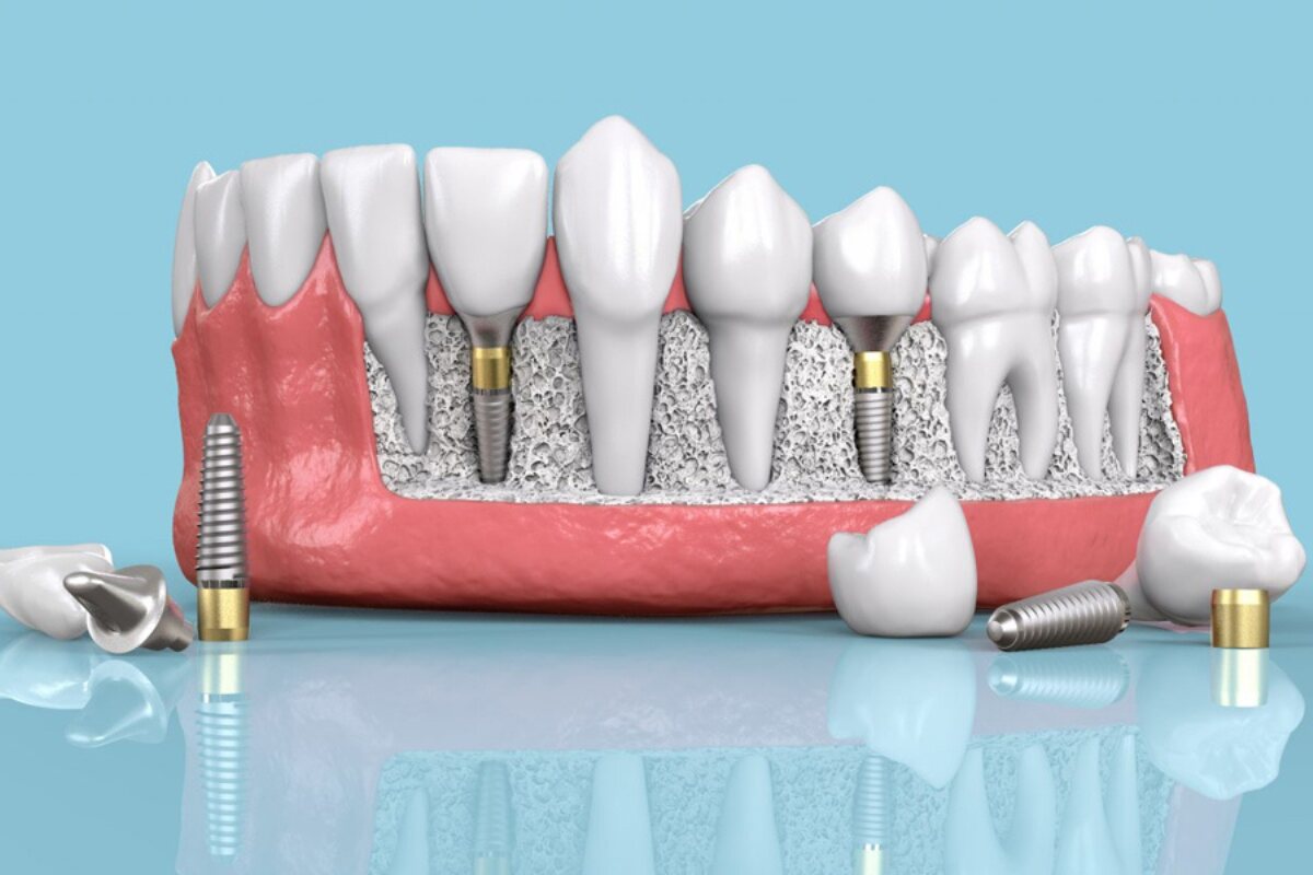 can a dental implant be done in one day