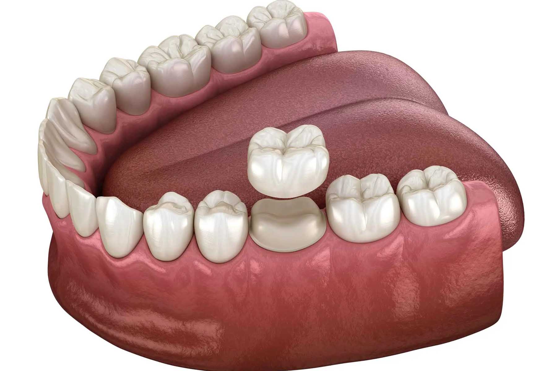 A Step by Step Guide To The Dental Crown Procedure