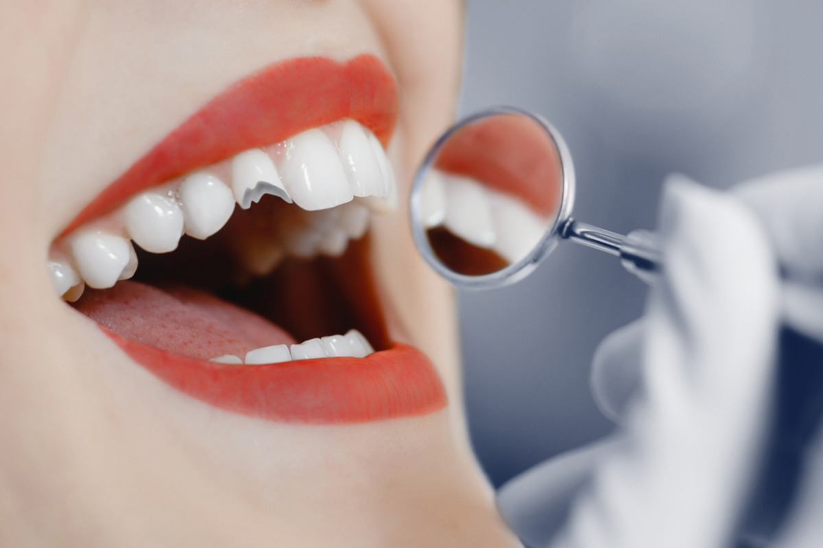 how to restore a chipped tooth what you need to know