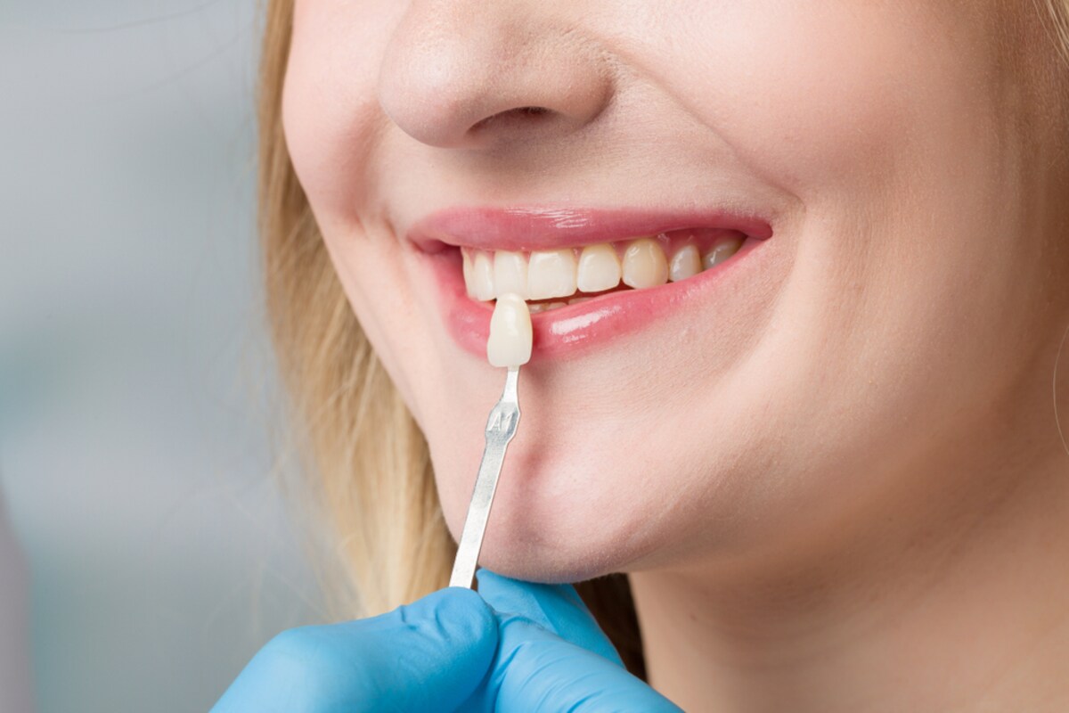 can porcelain veneers harm your teeth