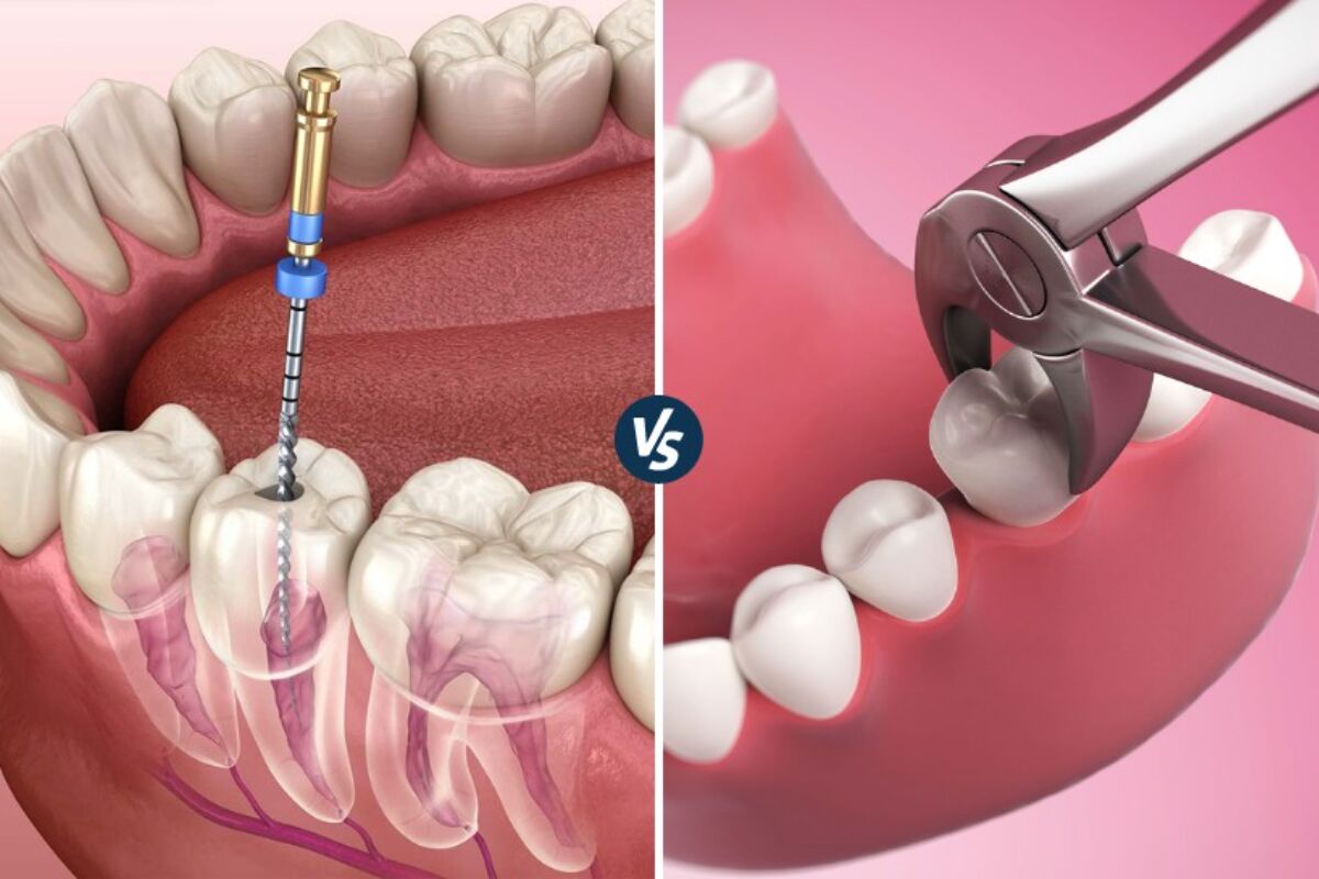 root canal vs extraction which is right for you in kitchener