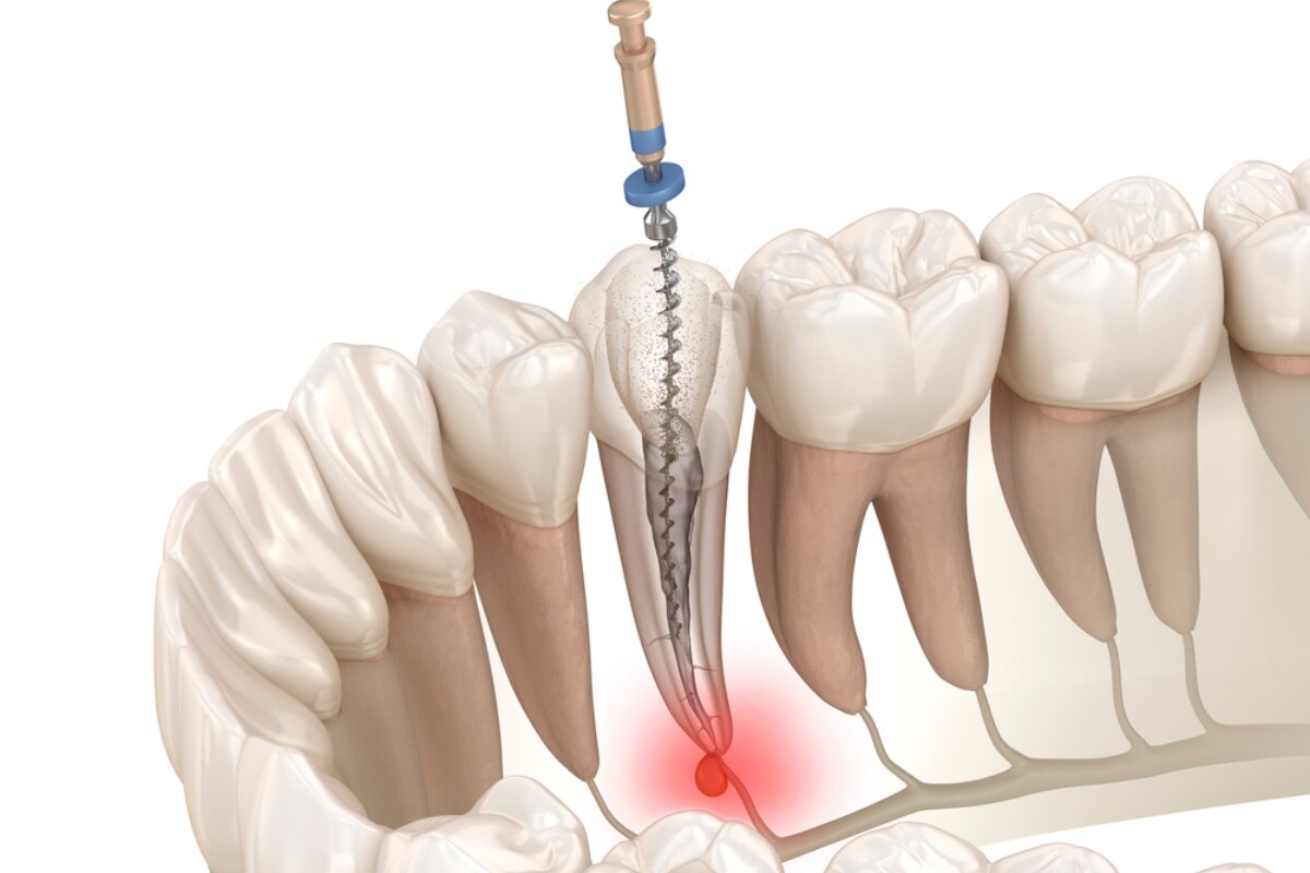 aftercare tips for a successful root canal recovery