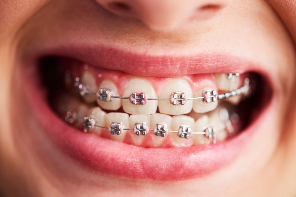 truth about getting braces as an adult what you need to know