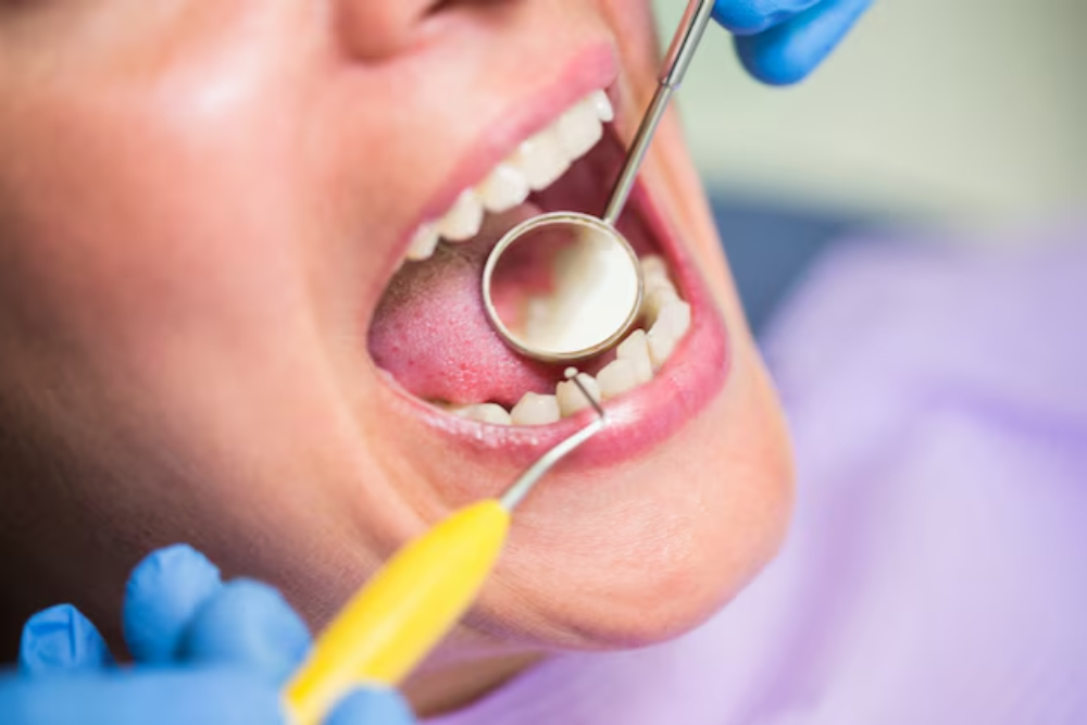 dentist placing a white composite filling in a decayed tooth